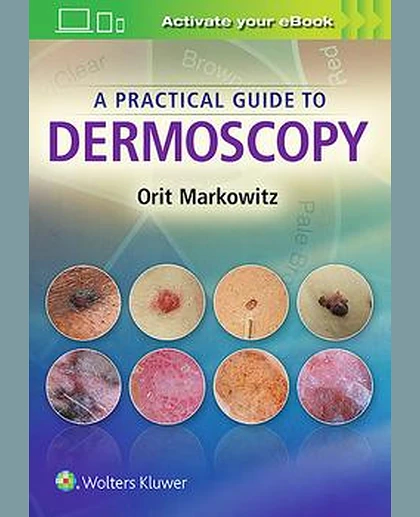 A Practical Guide to Dermoscopy