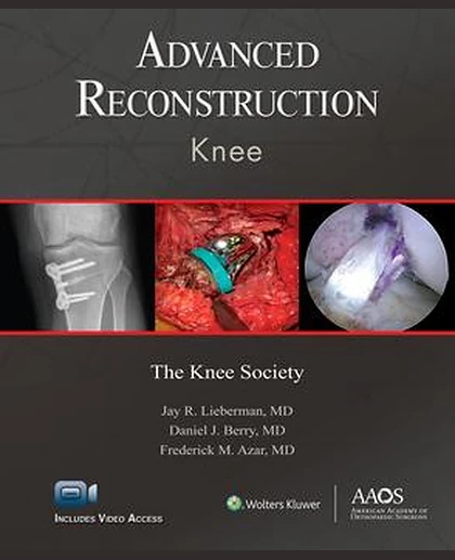 Advanced Reconstruction: Knee