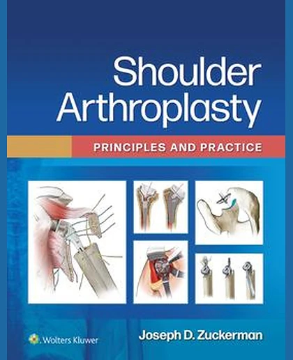 Shoulder Arthroplasty