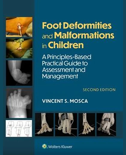 Foot Deformities and Malformations in Children