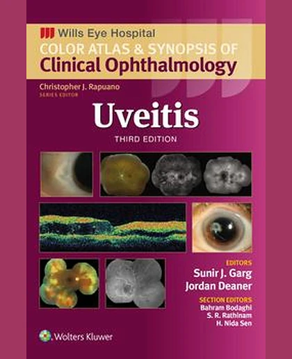 Uveitis