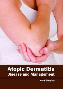 Atopic Dermatitis: Disease and Management