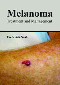 Melanoma: Treatment and Management