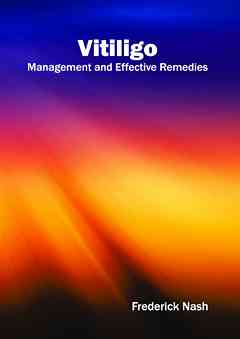 Vitiligo: Management and Effective Remedies