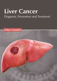 Liver Cancer: Diagnosis, Prevention and Treatment