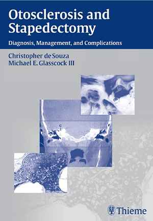 Otosclerosis and Stapedectomy: Diagnosis, Management, and Complications 1st