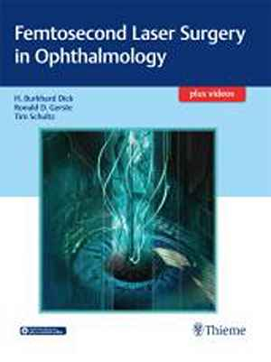 Femtosecond Laser Surgery in Ophthalmology 1st