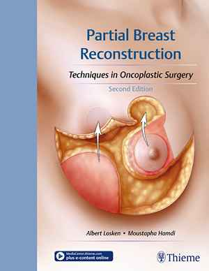 Partial Breast Reconstruction: Techniques in Oncoplastic Surgery 2nd