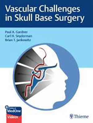 Vascular Challenges in Skull Base Surgery 1st