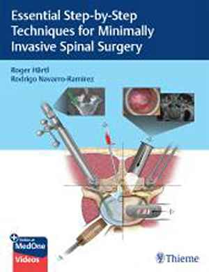 Essential Step-by-Step Techniques for Minimally Invasive Spinal Surgery 1st