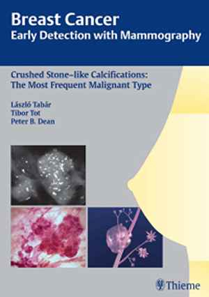 Breast Cancer: Early Detection with Mammography: Crushed Stone-like Calcifications: The Most Frequent Malignant Type 1st