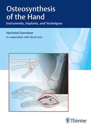 Osteosynthesis of the Hand: Instruments, Implants, and Techniques 1st