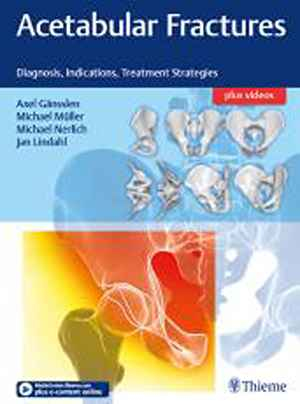 Acetabular Fractures: Diagnosis, Indications, Treatment Strategies 1st