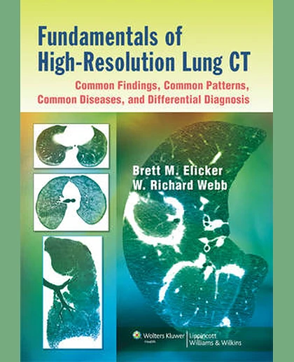 Fundamentals of High-Resolution Lung CT: Common Findings, Common Patterns, Common Diseases, and Differential Diagnosis: Common Findings, Common Patters, Common Diseases and Differential Diagnosis