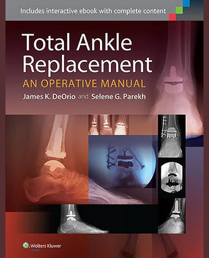 Total Ankle Replacement: An Operative Manual