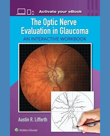 The Optic Nerve Evaluation in Glaucoma