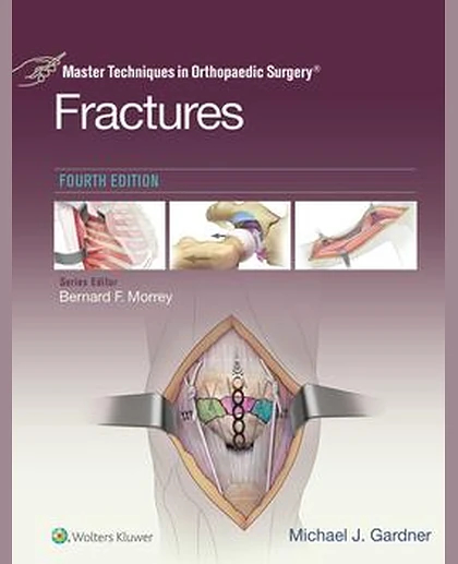Master Techniques in Orthopaedic Surgery: Fractures
