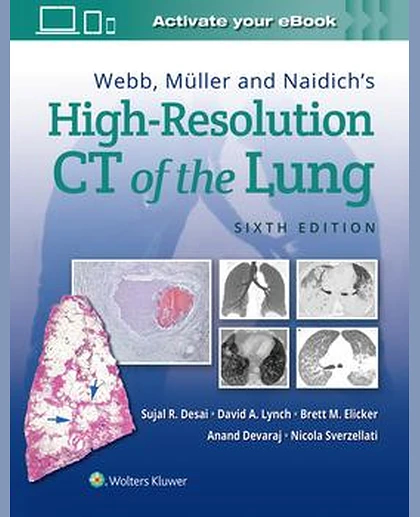 Webb, Müller and Naidich's High-Resolution CT of the Lung