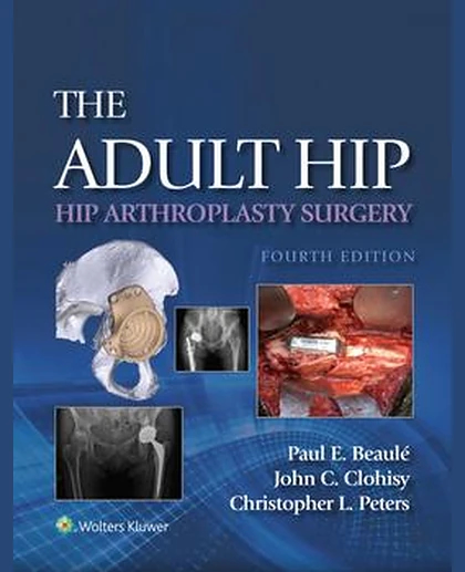 The Adult Hip: Hip Arthroplasty Surgery